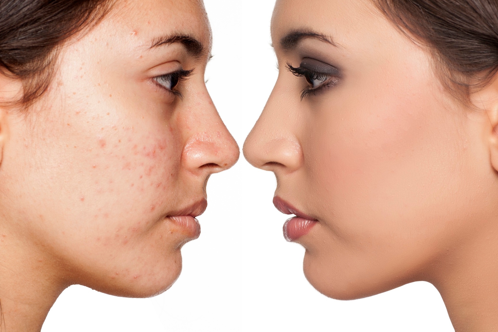 Moderate to Severe Acne: A Treatment Guide